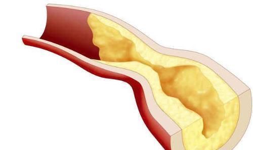 逆转|动脉粥样硬化可以逆转，一招可将血管壁清理干净，软化血管溶血栓
