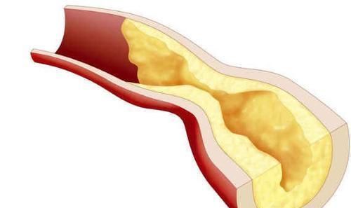 逆转|动脉粥样硬化可以逆转,一招可将血管壁清理干净,软化血管溶血栓
