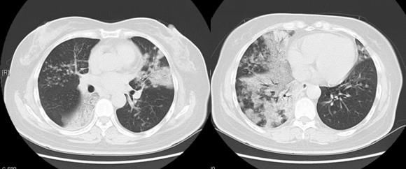  这类肺结节容易漏诊，错把肺癌当肺炎