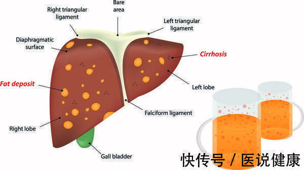一行为|喜欢喝酒的人,防止酒精肝找上门,现在开始做好8件事,还来得及