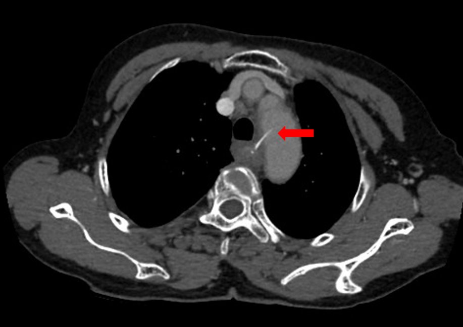 食管|女子硬吞饭团把鱼刺扎进主动脉医生：鱼刺卡喉后“土法”不可取