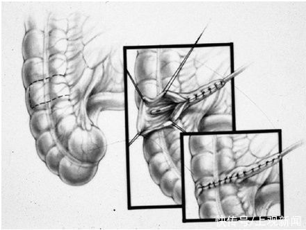 患儿|7岁男孩便便不受控,无法上学!马龙手术来解决,没有阑尾,还可造个