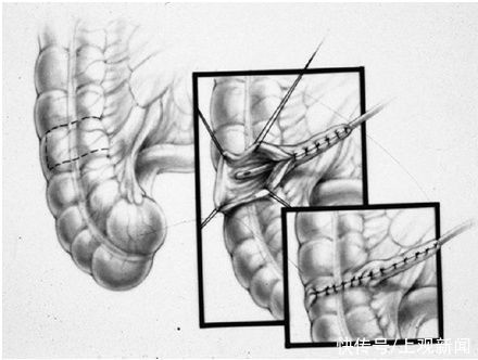 患儿|7岁男孩便便不受控，无法上学！马龙手术来解决，没有阑尾，还可造个