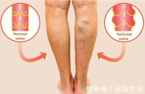 血管|当手上有这4个信号,表示血管堵塞很严重,要及时治疗