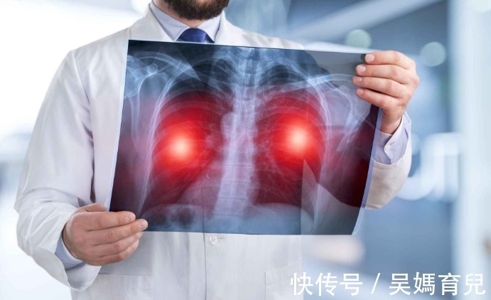 切除|体检结果显示有肺结节,严重吗?确诊肺结节,要马上切除吗?