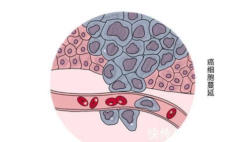 癌症|肿瘤不等于癌症,两者到底有什么区别看完就安心了