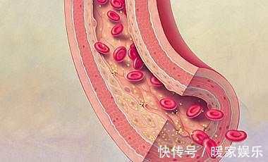 血管|家里有血栓病人,这5样常见食物,可帮你清血管,吃的越多越好