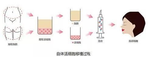 注射隆鼻 隆鼻手术一般多少钱？隆鼻能保持多久？