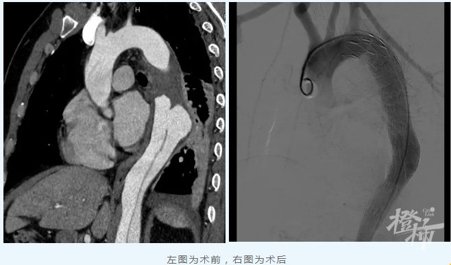 主动脉|35岁工程师晚上加完班走出公司,胸背突然撕裂般疼痛,生命垂危