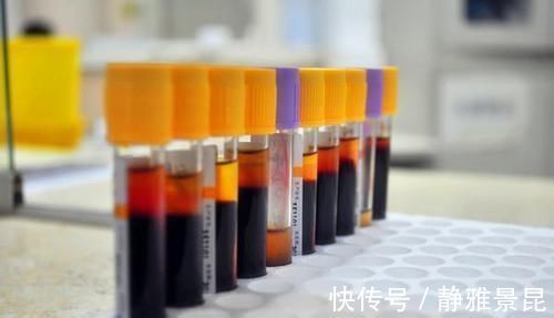 胰岛素抵抗|高血压患者,请注意你的“同型半胱氨酸”值!高了容易中风