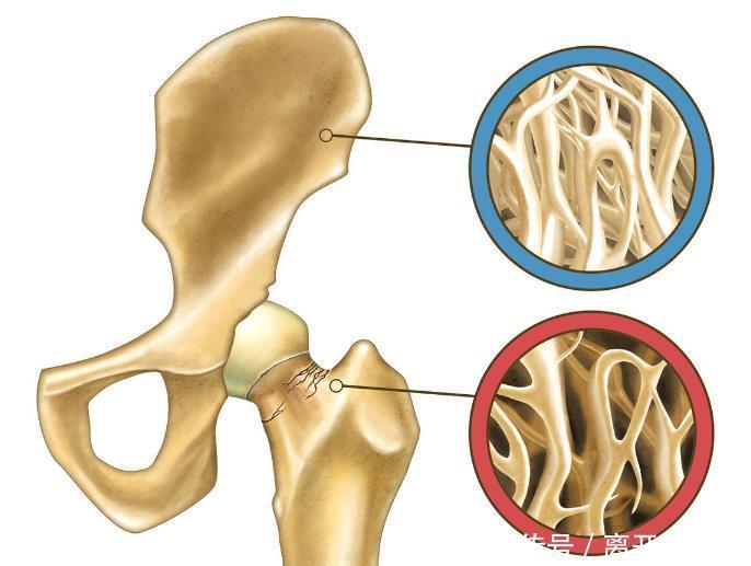  骨密度|骨科医生大葱和它这样用，增强骨密度，骨质疏松不攻自破