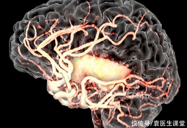 药物治疗|房颤，让卒中风险高3-5倍!医生教你如何正确对待