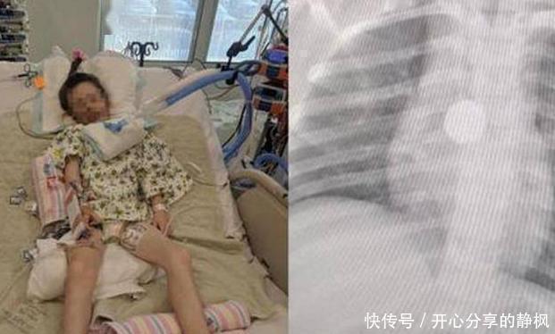 家长们|6岁女儿突然暴瘦,拍片检查时医生让摘下项链,妈妈:哪有项链?