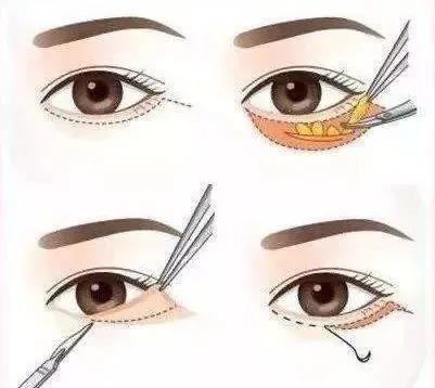 眼周状态出卖了你的年龄!