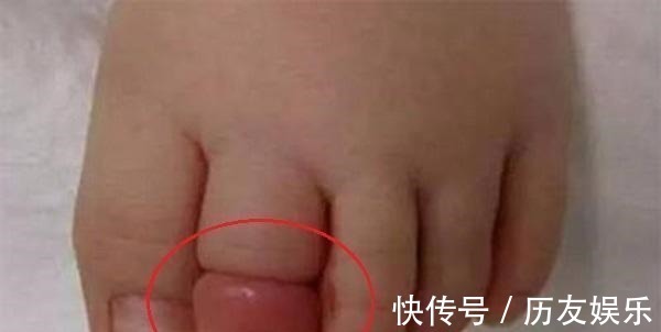宝宝|11月龄宝宝脚趾进“虫”,家长紧急送医,医生直言幸好来得早