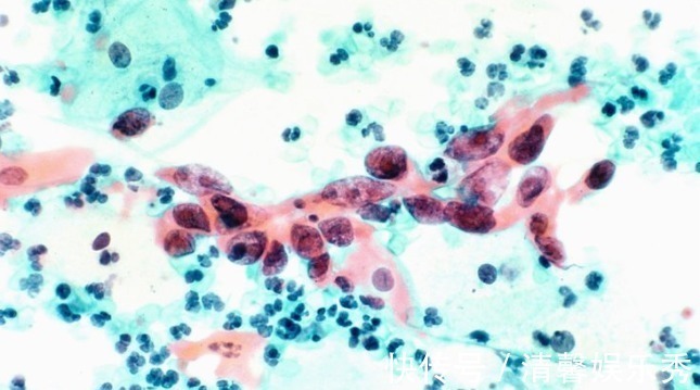 癌细胞|哪些人最容易得癌症？看完这份“名单”吓一跳！看看是否有你