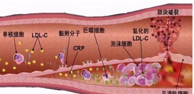 斑块|冠心病，是由什么原因引起来的？听听医生怎么说