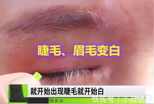 爱美之心 女子割双眼皮后变“白眉大侠”，找美容院讨要说法是手术造成的