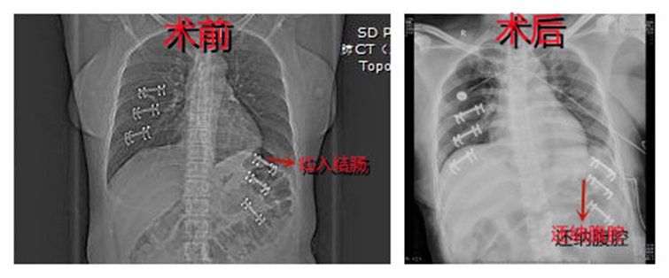 山东省立三院胸外科:急症腔镜膈疝修补术,还原“失位”的器官|品牌专科 | 李女士