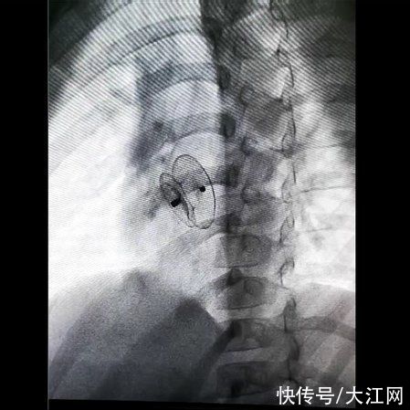 程应樟|「护心佑民」南大二附院程应樟教授团队为免费救治的先心病姐弟成功实施介入手术