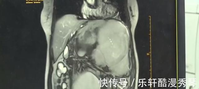 医生|恶性肿瘤1个变3个,挤满女子腹腔,医生直呼没见过!