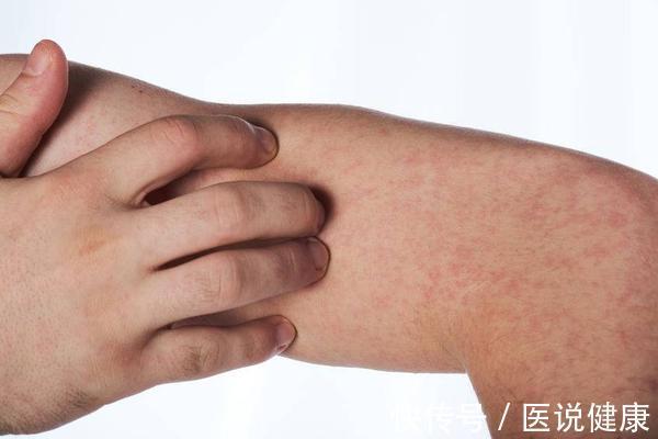 治疗|医生指出:得了荨麻疹,做好这5件事,或许可以帮你缓解症状