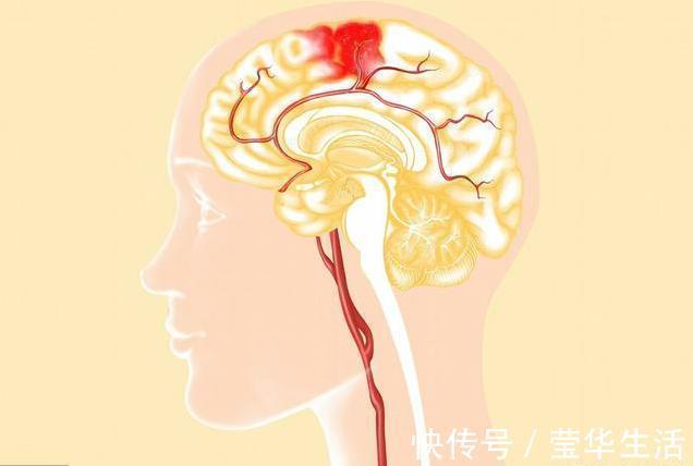 颅内压|脑出血就是脑溢血,医生提醒养成10个好习惯,脑血管才安全