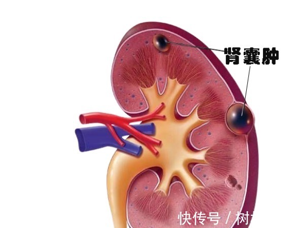 科室|结节、息肉、囊肿、增生哪个最可能癌变这么多年疑惑终于解开了