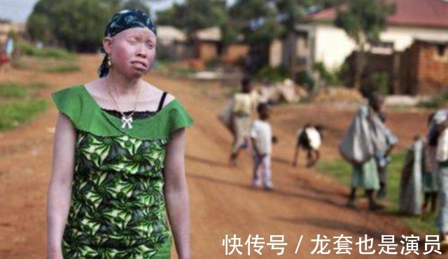 病人@非洲版“唐僧”:皮肤全白,血液比黄金还贵,死后遗骸能卖上百万