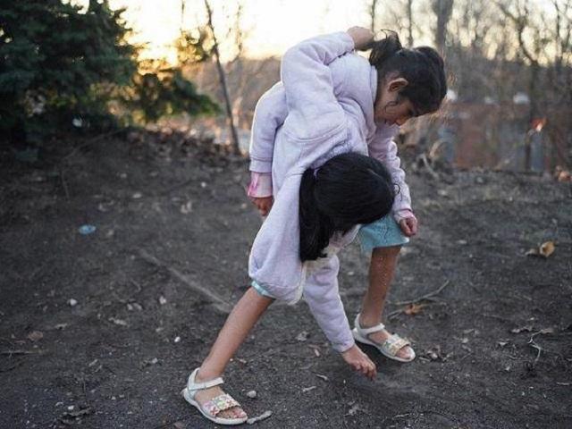 孩子|17年前的连体女婴,医生说“只能活3天”,如今现状超乎众人意料