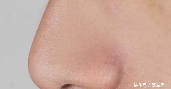 毛孔|鼻翼两侧挤出白色分泌物是啥?别再用手挤了,当心越来越多