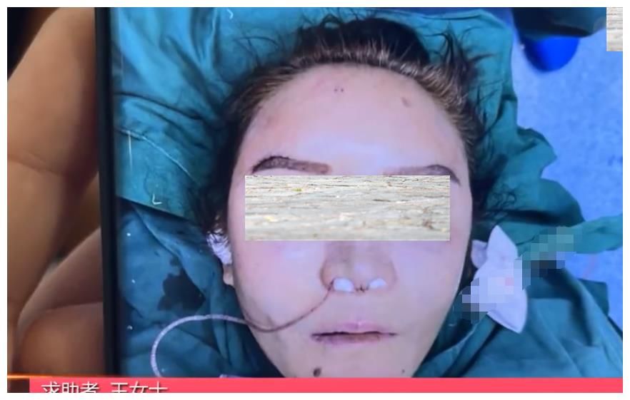 面部吸脂手术|河南女子做面部吸脂失败,笑比哭还难看,商家:赔偿1万我们两清
