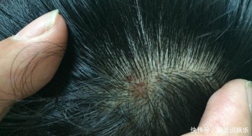 油脂|头皮上长出“小疙瘩”,可能是有大问题,为了家里人健康了解下!