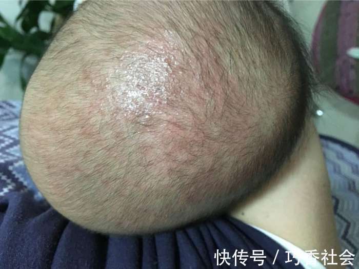 医生|刚满月的宝宝就高烧不退!医生看到宝宝的头皮后怒斥她不配做妈妈