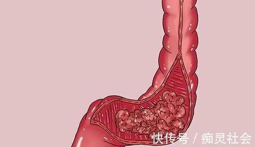 肠癌|经常腹泻,是不是得了肠癌?医生:肠癌还有2个明显特征,对照下