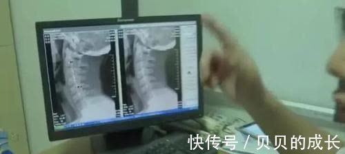 颈椎病|孩子一年来一直做一件事,妈妈发现后立刻送医,医生却说:来晚了