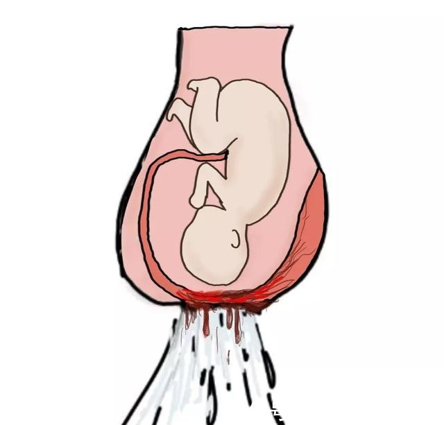 产科医生笔记之产前出血最危险因素——前置血管_【快资讯】