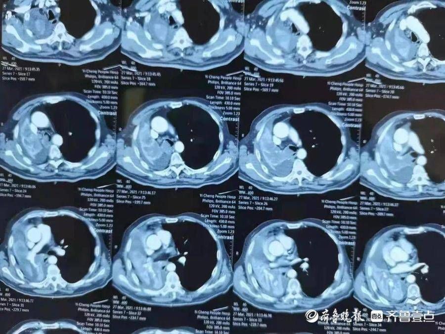 Zaozhuang Cancer Hospital completed a case of giant retrosternal thyroid surgery