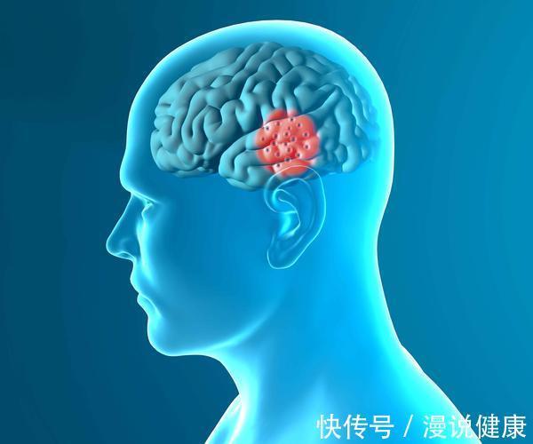 高血压|脑梗一般在哪个年龄段发作?出现3个特征,要重视