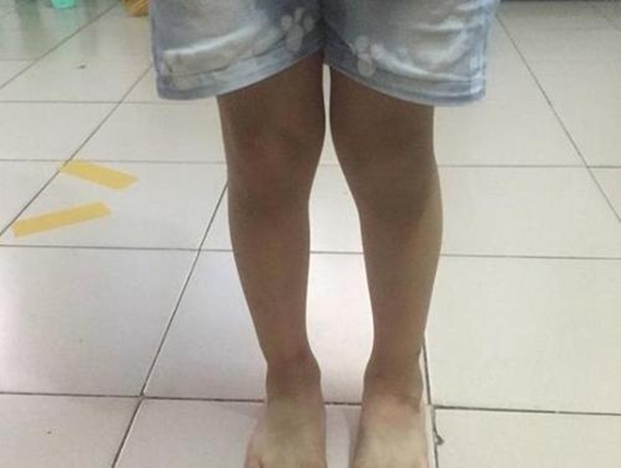 外国|为啥中国孩子那么多“罗圈腿”,外国孩子却很少,这些坏习惯要改