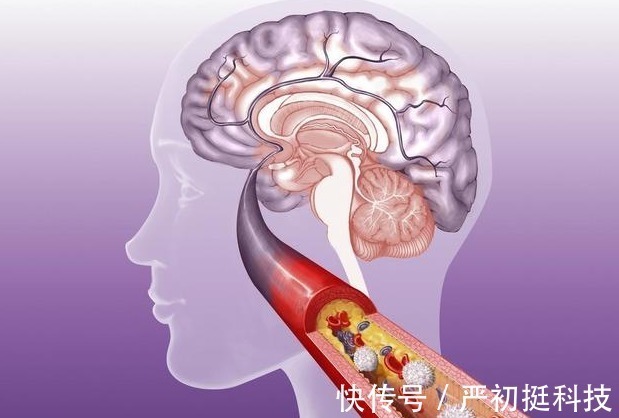 脑梗|无论男女,过了40岁尽量少吃3种食物,摆脱脑梗塞,身体更健康