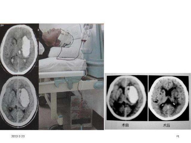 颅内压|脑出血就是脑溢血,医生提醒养成10个好习惯,脑血管才安全