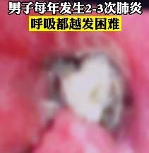 气管壁|男子啃鸭脖骨头卡进肺部，20年后终于...