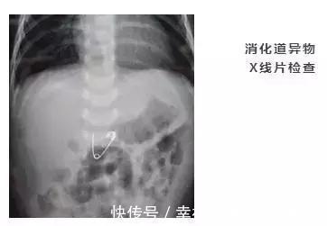 毒物|小小一枚,孩子喉管被腐蚀!再说一遍,这些东西必须放好了