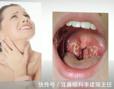 扁桃体炎|有个扁桃体炎孩子是什么体验？父母为什么下定决心要割了它！