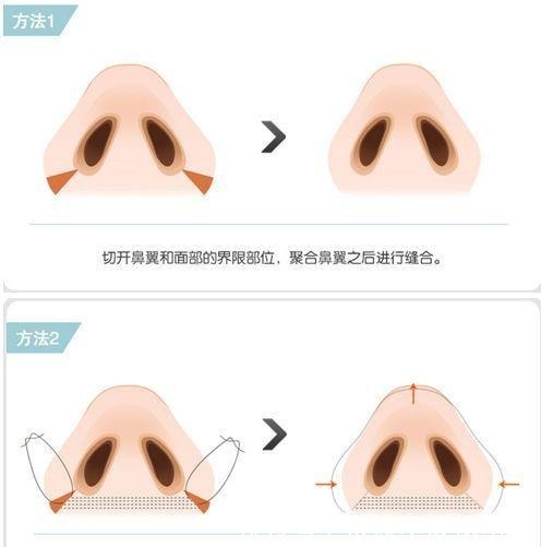 手术 王志坚医生可以单独只做鼻翼缩小手术吗!