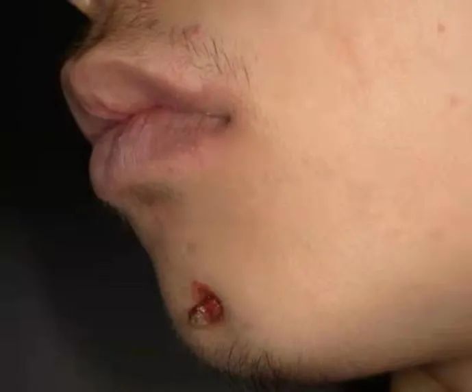 男孩|17岁男孩下巴长出了“肉芽”以为是青春痘,但病因竟出在牙齿上