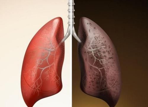 含糖饮料|肺部的“排毒器”公布，不是枇杷水，没事放开喝，肺干净，远离肺癌！