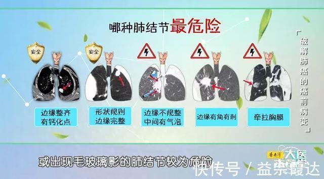 肺结节|CT照出肺结节,是不是得了肺癌医生终于说了大实话