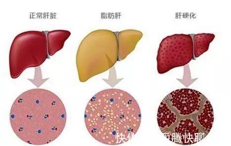 李兰娟|豆浆是肝病的“发物”吗?院士李兰娟:若想肝好,四类食物要少碰